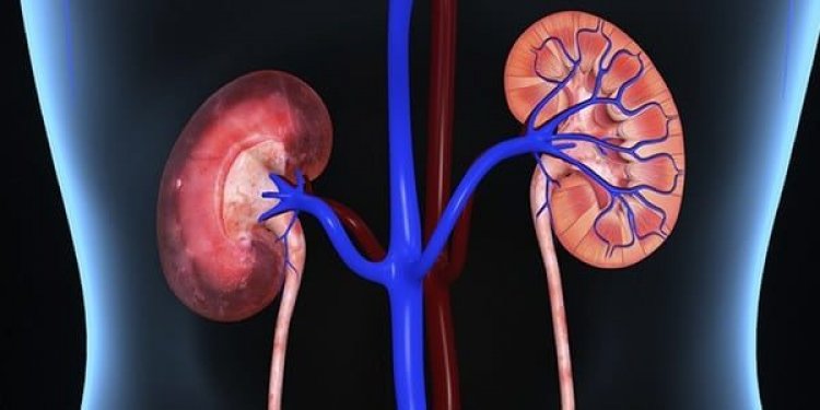 Kidney Stones Problem Recurs In 70 Percent Of Existing Patients within next 10 Years