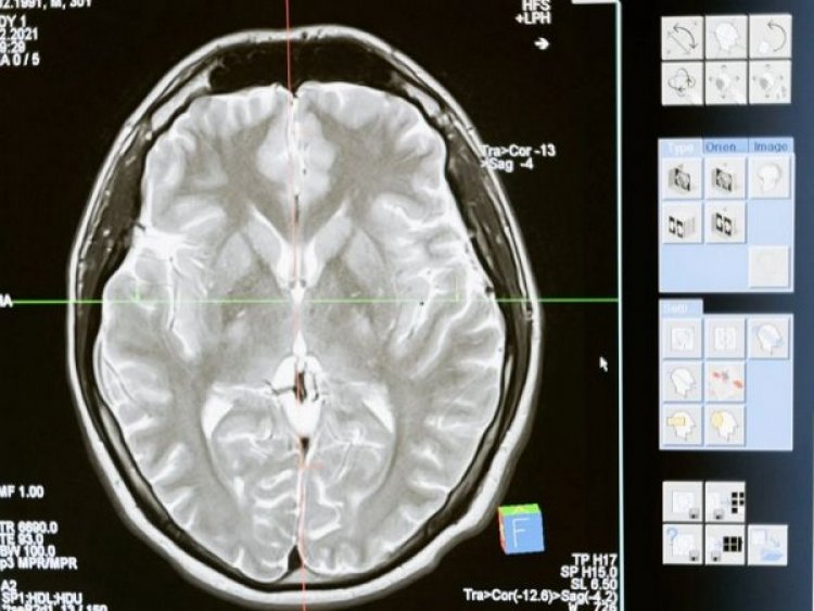 Damage to white matter linked to worse cognitive outcomes after brain injury: Study