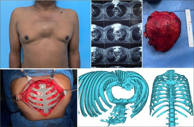 Technological advancement of 3D printing: Malignant Sternal Tumour patient undergoes complex cancer surgery and Entire sternum ribs reconstruction at Manipal Hospitals