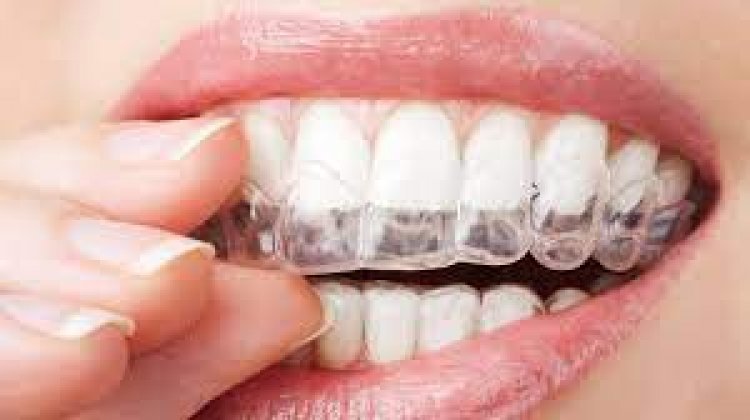 Invisalign: One Stop Solution For A Great Smile