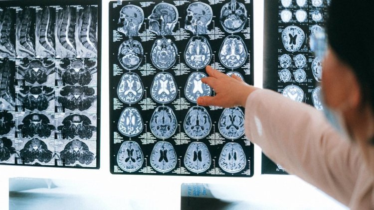 Researchers use MRI data to predict brain tumor progression