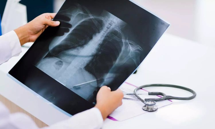 AI accurately identifies normal, abnormal chest X-rays: Research