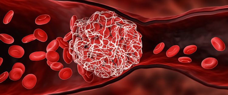 Study: Unique treatment attacks blood clots without raising blood risk