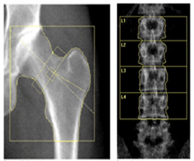 Researchers find how hormone therapy increases lumbar spine bone mineral density