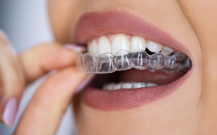 India's clear aligners market on the rise, likely to reach $500 million