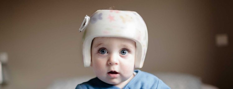 Researchers give insight into children with helmet therapy for a flattened head