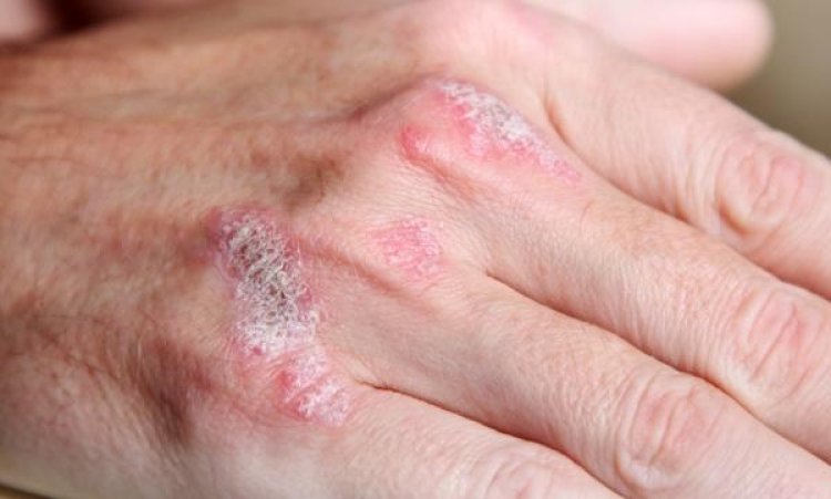 Study links severe psoriasis to higher risk for heart disease