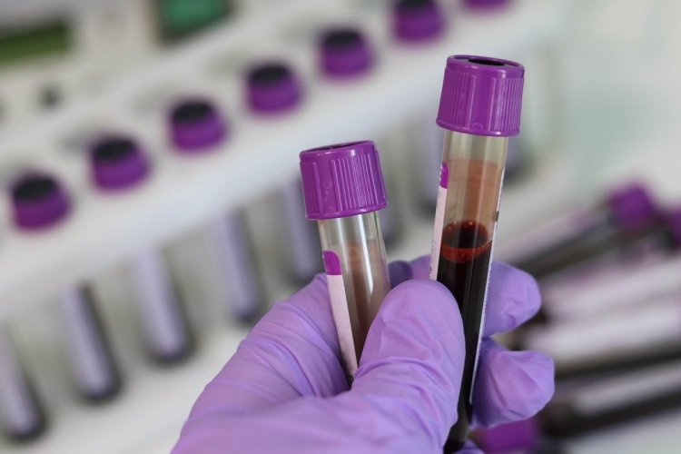 Simple blood test might help diagnose bipolar disorder: Research