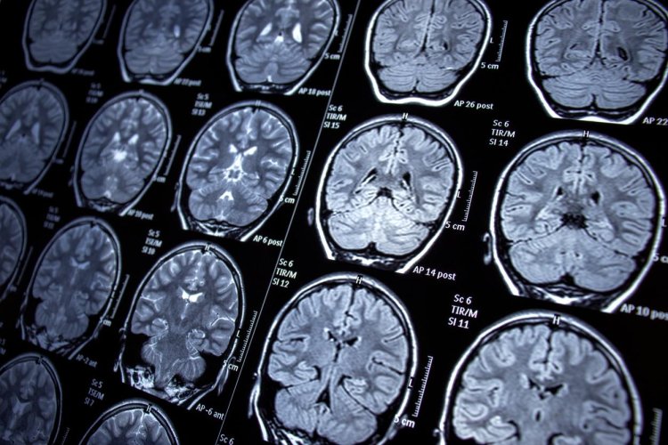 Researchers find how anti-cancer drug can improve symptoms after stroke