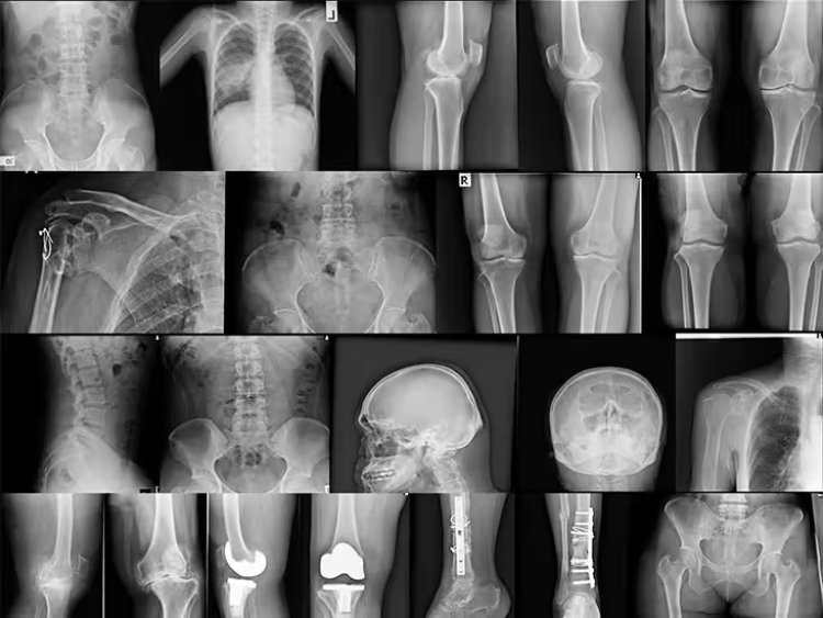 Researchers give more insight into bone diseases