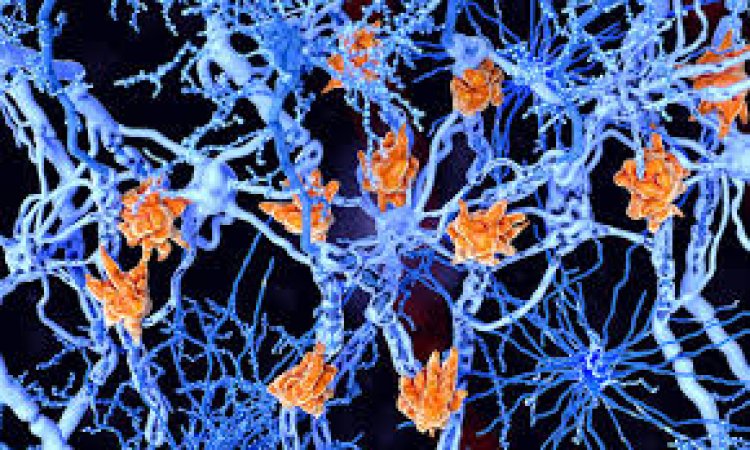 Researchers discover new biomarker to diagnose Alzheimer's in asymptomatic stages