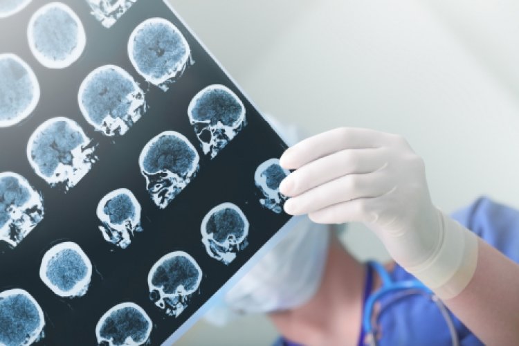 Study finds how blood cancer medication makes radiotherapy on brain tumours more effective