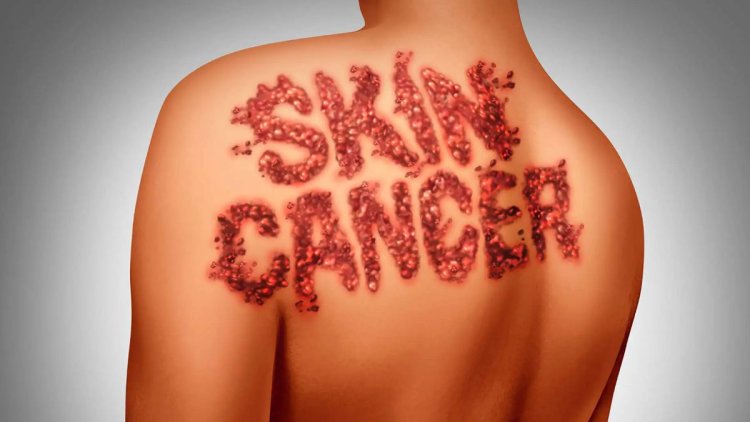 Study finds how skin cancer occurrence in young adults declines