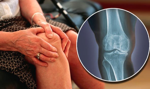 A 68-year-old woman with osteoarthritis successfully treated at Kohinoor Hospital