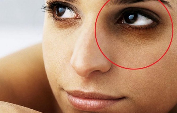 Have Got Dark Circles? Here's how you can treat them!