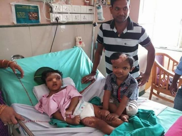 Jaga, Kalia return to Odisha 2 years after successful separation surgery