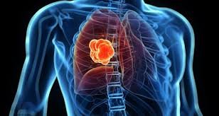 Know Everything about Lung Cancer