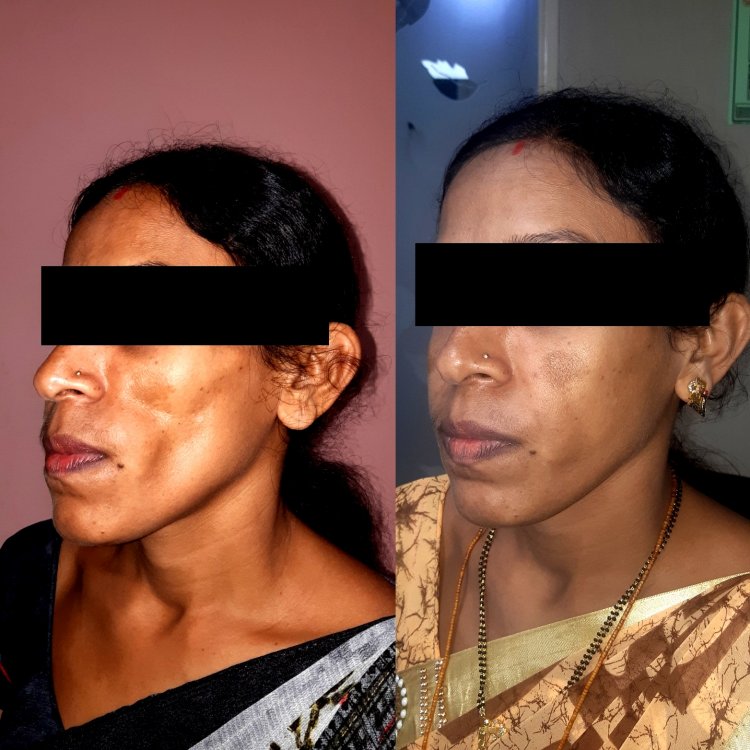 Wockhardt Hospital successfully treats 35 year old Mumbai woman with cheek deformity