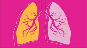 All You Need To Know About COPD - the Common Lung Disease in India