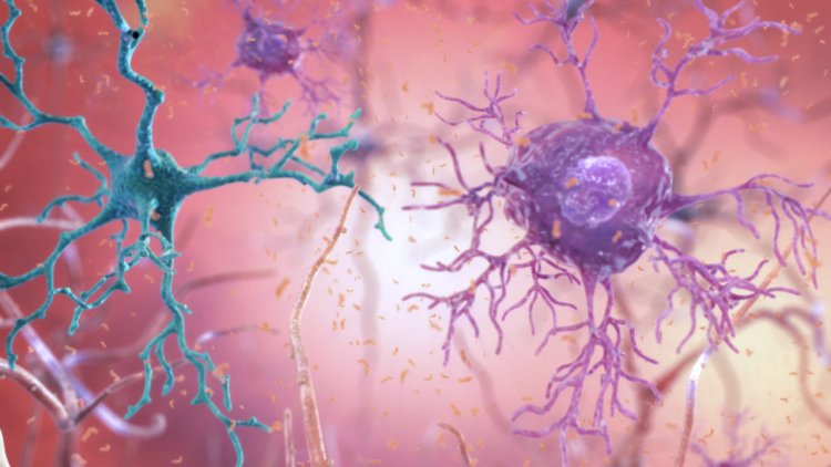 First Choice Neurology BAN2401 Study to Assess New Alzheimer's Treatment