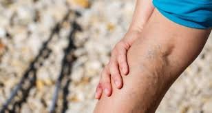 Do Varicose Veins run in your family?