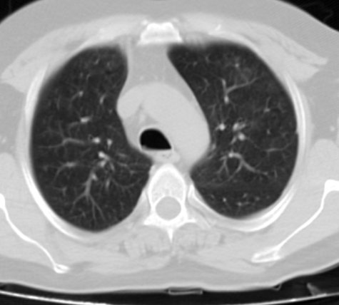 Zen Hospital Managed A 49-year-old Man with Brucella Pneumonia in the midst of Corona