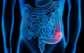 48-Year-Old Woman with Rectal Cancer Successfully Treated