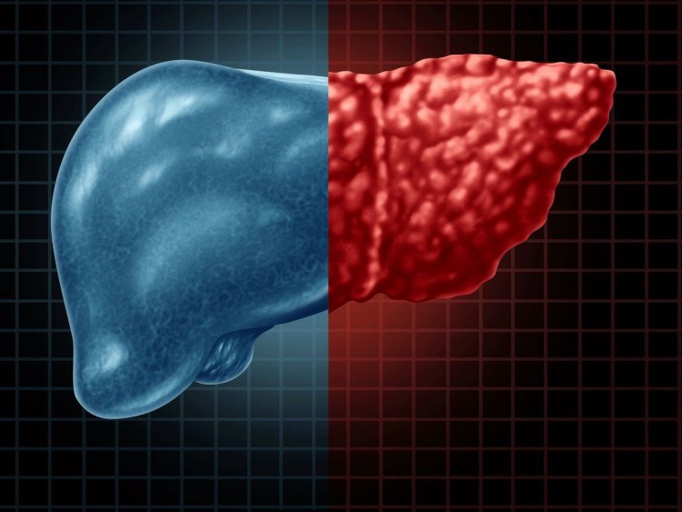 Spurt In Cases Of Hepatitis Associated With Fatty Liver, Warns Doctor