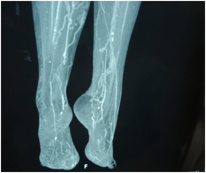 60-Year-Old Man Delays Treatment Due to COVID Fear, Ends Up with Uncontrolled Diabetes and Gangrene in Left Leg