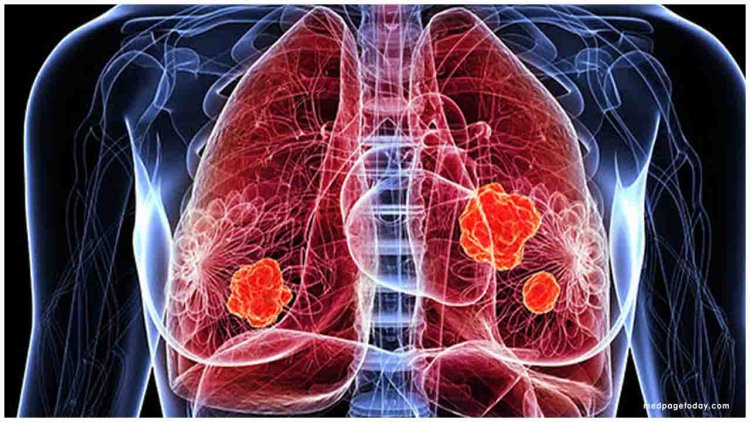 FDA Approves First Adjuvant Therapy for Most Common Type of Lung Cancer
