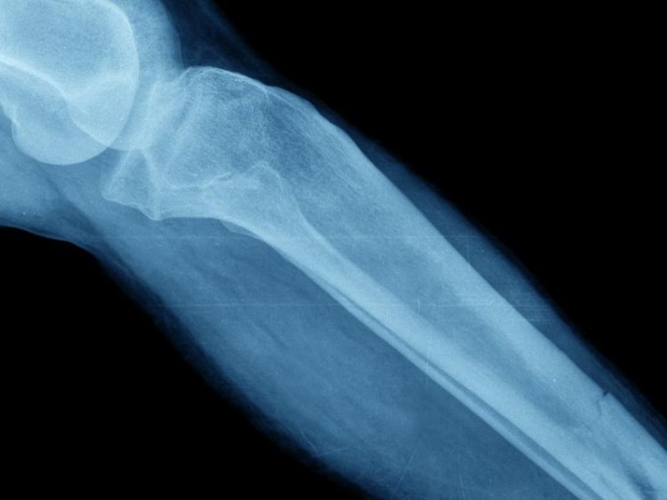 Bone fracture risk may increase when critical enzymatic processes decline